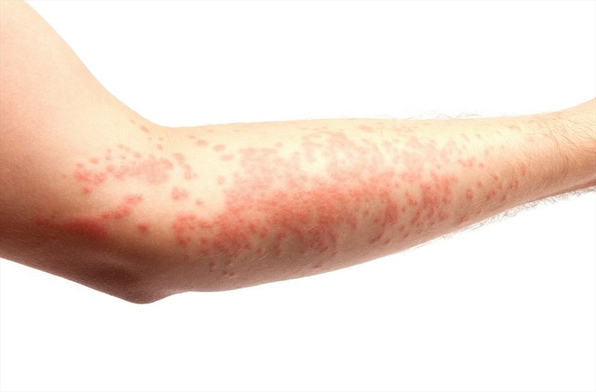 Diagnostyka i leczenie chorób skóry, Dermatolog Małgorzata Karska Piła, Piła